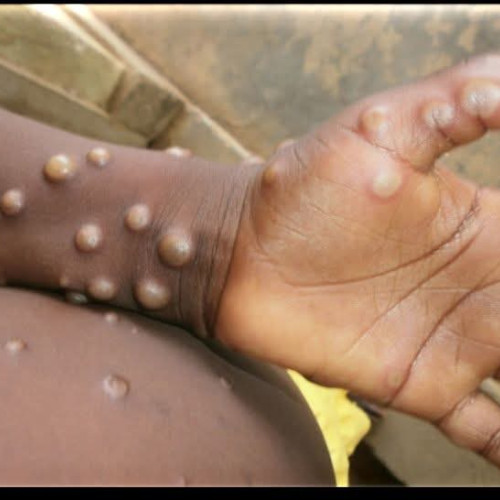 Europa, în alertă medicală! Primul caz de nouă variantă a virusului mpox raportat în Franța